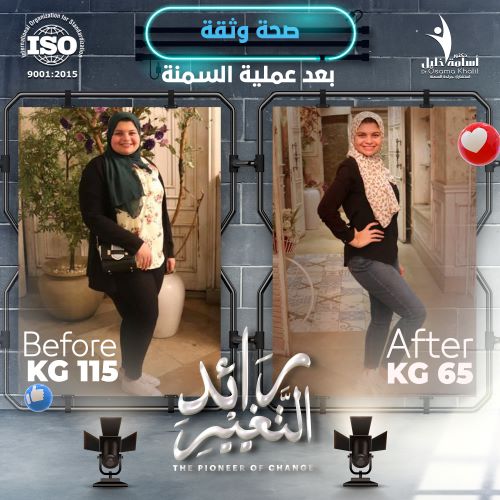 ما هو معدل نزول الوزن بعد عملية تحويل المسار ؟